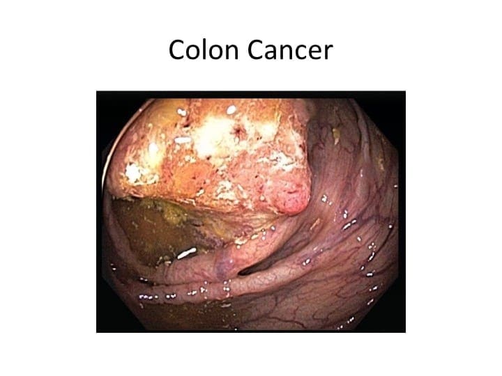 causes of colon cancer pdf