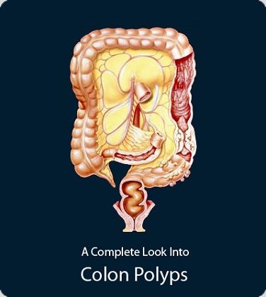 causes of colon cancer pdf